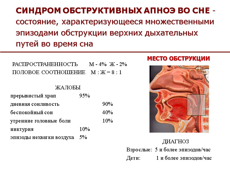 СИНДРОМ ОБСТРУКТИВНЫХ АПНОЭ ВО СНЕ - состояние, характеризующееся множественными эпизодами обструкции верхних дыхательных путей